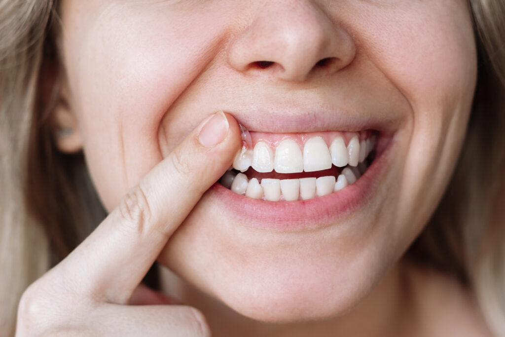 Periodoncia young woman applying mineralizing gel teeth strengthening restoring whitening